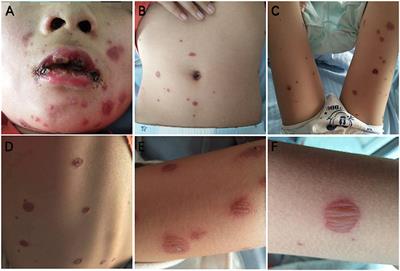 Case Report: Clinical and Immunological Features of a Chinese Cohort With Mycoplasma-Induced Rash and Mucositis